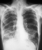 Tuberculosis,X-ray
