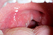 Infected tonsil