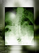 Gases in the abdomen,X-ray