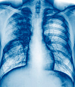 Tuberculosis,X-ray