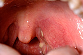 Inflamed tonsil