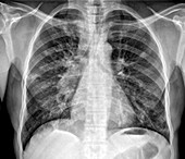Tuberculosis pneumonia,X-ray