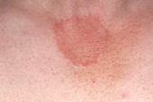 Ringworm fungal skin infection