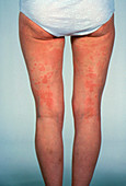 Urticaria affecting the back of a woman's legs