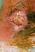 Close-up of a varicose ulcer