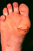Ulceration of the sole of the foot (of diabetic)