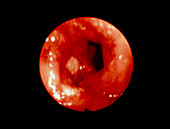 Endoscope image of a duodenal ulcer