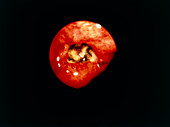 Endoscope image of bleeding gastric ulcer