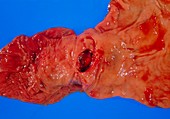 Bleeding gastric ulcer in excised part of stomach