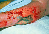 Varicose ulcers affecting the lower leg