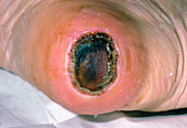 Close up of pressure sore (ulcer) on heel