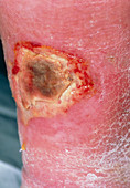 Hypostatic leg ulcer