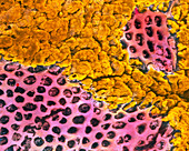 Coloured SEM of gastric ulceration in a human