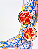 Artwork of varicose veins & leg ulcers