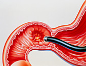 Artwork of duodenal ulcer & endoscope