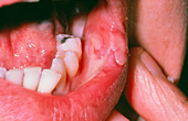Aphthous ulcer inside lower lip