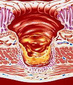 Artwork showing close-up of gastric ulcer