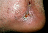 Close-up of varicose ulcer on ankle of patient