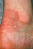 Urticaria rash (hives) on ankle due to nettles