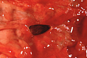 Peptic ulcer,gross specimen