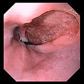 Oesophagus ulcer