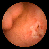 Duodenal ulcer,pill camera view