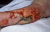 Varicose leg ulcer