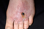 Foot ulcer