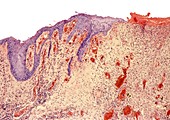 Healing skin ulcer,light micrograph