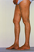 Varicose veins affecting legs and feet of female