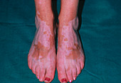 Vitiligo affecting woman's feet