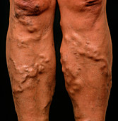 Varicose veins on a woman's legs