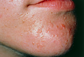 Common warts on boy's chin