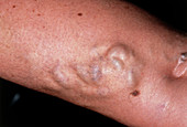 Close up: varicose veins behind woman's knee