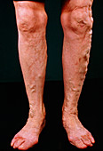 Varicose veins on the legs with ulceration of toes