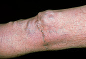 Varicose veins around the knee