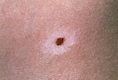 Vitiligo seen around a pigmented naevus