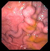 Gastric varicose veins