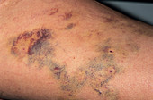 Legs after varicose vein surgery