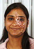 Vitiligo skin disorder