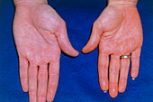 Hands of a person with the condition Xanthaemia