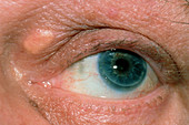 Xanthoma or deposit of fatty material on the eye
