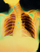 Col X-ray of safety pins lodged in oesophagus