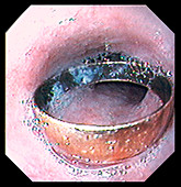 Swallowed ring