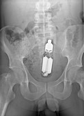 Sex toy in man's rectum,X-ray