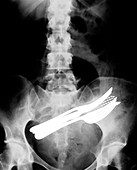 Swallowed household objects,X-ray