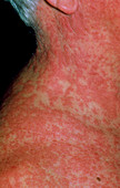 Extensive rash due to drug reaction