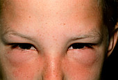 Hay fever: child's face with swollen eyes