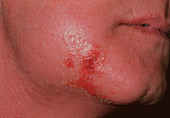 Infected insect bite on a patient's face