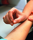 Skin prick test for allergens on a child's arm